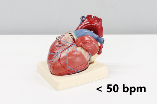 Cardionica - bradykardie.jpg